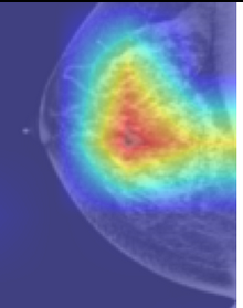 Mammography AI for Early Detection
